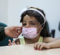 Suriyeli küçük Hane'nin yüzü doku nakliyle güldü