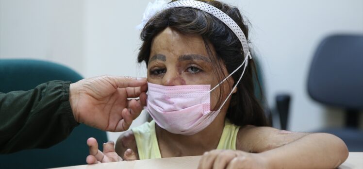 Suriyeli küçük Hane'nin yüzü doku nakliyle güldü