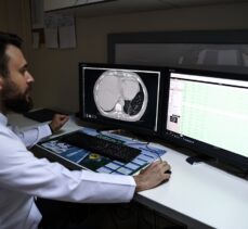 Bilgisayarlı tomografide Kovid-19'u 50 saniyede tespit edebilen yapay zeka yazılımı geliştirildi
