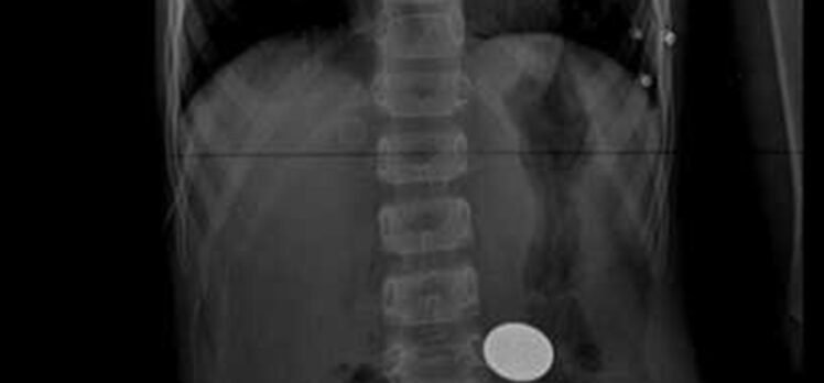 Denizli'de 5 yaşındaki çocuğun yuttuğu madeni para endoskopiyle çıkarıldı