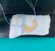 Samsun'da bir hastaya menisküs nakli yapıldı